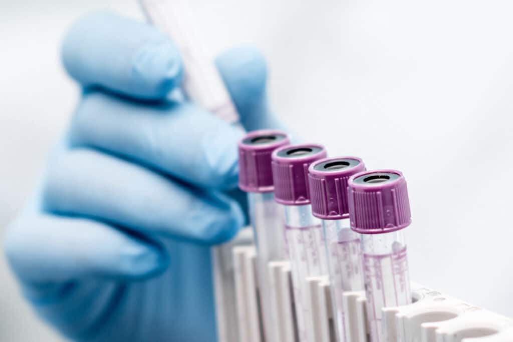 Blood test tubes used for thyroid panel testing in type 1 diabetes